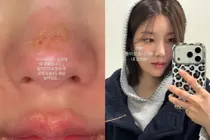 What Happened to Kwon Eun-bi’s Face?