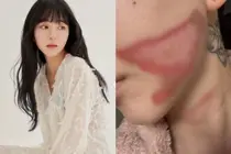 AOA Kwon Min-ah, Horrific 2nd Degree Burns After Skin Treatment... What Happened?