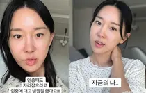 “看起来更年轻的秘诀？”李智惠接受的人中缩短术是否存在副作用？
