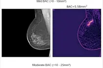 AI Mammogram Analysis: Predicting Cardiovascular Disease Risk Through Breast Cancer Screening