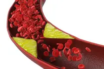 Đại chuyển đổi công thức quản lý Cholesterol