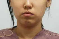 Why Reducing Your Face Can Make It Look Longer: The Hidden Risks of Midface Surgery