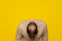 Umbilical Cord-Derived Stem Cell Therapy Offers New Hope for Treatment-Resistant Hair Loss