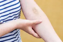 Mysterious Black-and-Blue Marks? The Surprising Reasons You Might Be Bruising Easily