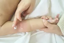 Elevated Phthalate Levels in Newborn Urine Linked to Dramatic Rise in Childhood Atopic Dermatitis