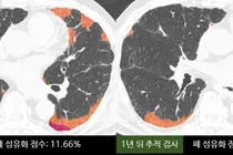 AI Tracks Lung Scarring: 4-Percentage-Point Rise in One Year Signals Danger