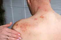 Why Skin Barriers Collapse in Atopic Dermatitis: Researchers Identify Rogue Protein Pair