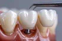 Implants dentaires chez les seniors : quatre points à vérifier avant de se lancer