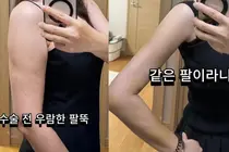 「上腕の脂肪を1700cc吸引」女優キム・ハヨン、脂肪吸引後の「一直線の腕」を公開