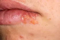 Blisters Around the Lips Again: 