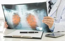 AI yang Menemukan Pasien Kanker Paru yang Merespons Imunoterapi dengan Baik