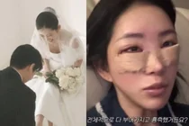 Choi Jun-hee, encore une chirurgie esthétique avant le mariage ? 