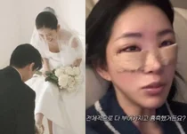 Choi Jun-hee lại phẫu thuật thẩm mỹ ngay sát ngày cưới?: “Hài lòng vì gương mặt trông mềm mại hơn”