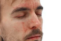 “I Thought It Was a Bad Cold”…Shingles: Miss the 72-Hour ‘Golden Time’ and You Could Suffer for Years