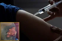 “Dolor por inyección de analgésicos y piel de los glúteos en descomposición”… Hombre de 51 años sufre de ‘este síndrome’, ¿qué es?