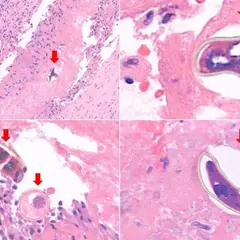 Suspected Lung Cancer Turns Out to Be Parasite Eggs From Raw Freshwater Crab