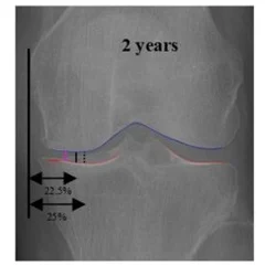 Diagnosis Osteoartritis Lutut dengan AI daripada X-ray: Peneliti Korea Mengembangkan Indikator Baru