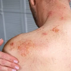Why Skin Barriers Collapse in Atopic Dermatitis: Researchers Identify Rogue Protein Pair