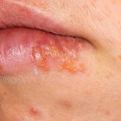 Cold Sore Before an Important Event? Why Lip Blisters Recur—and How to Spot the Early Signs