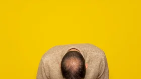 Umbilical Cord-Derived Stem Cell Therapy Offers New Hope for Treatment-Resistant Hair Loss