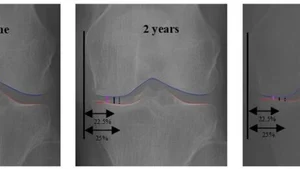 Diagnosis Osteoartritis Lutut dengan AI daripada X-ray: Peneliti Korea Mengembangkan Indikator Baru