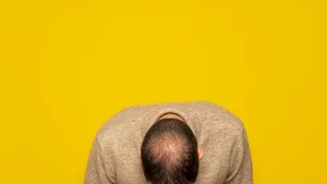 Umbilical Cord-Derived Stem Cell Therapy Offers New Hope for Treatment-Resistant Hair Loss