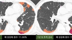 Fibrose pulmonaire idiopathique : l’IA mesure la rigidification des poumons, +4 points en un an est un signal d’alerte