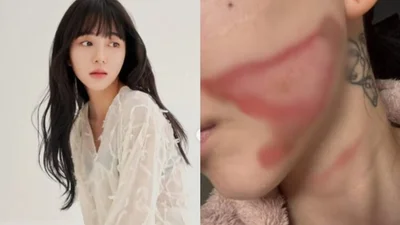 AOAのクォン・ミナ、皮膚施術を受けて2度の火傷に…一体なぜこんなことが？