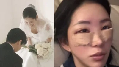 Choi Jun-hee, encore une chirurgie esthétique avant le mariage ? 