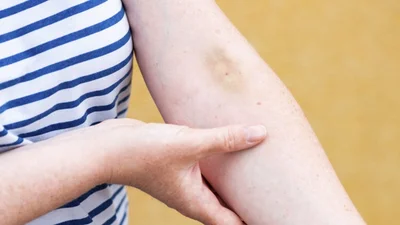 Mysterious Black-and-Blue Marks? The Surprising Reasons You Might Be Bruising Easily