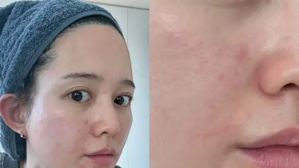 Nam Bora, Where Did Her Glowing Skin Go? 