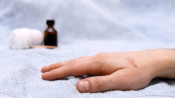 Diabetes Drug Repurposed: Evogliptin Shows Promise in Preventing Disfiguring Burn Scars