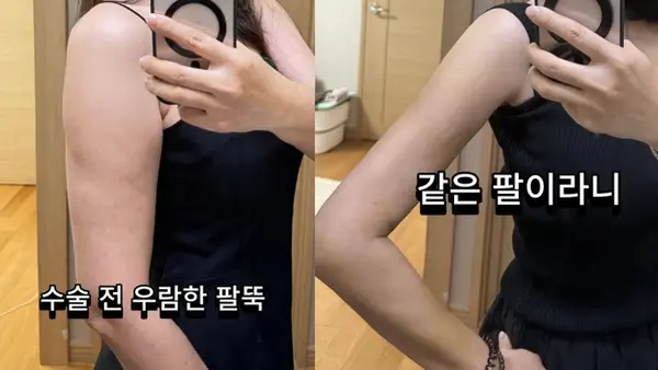 Actor Kim Ha-young Reveals Post-Liposuction Results After Removing 1,700 cc of Upper-Arm Fat