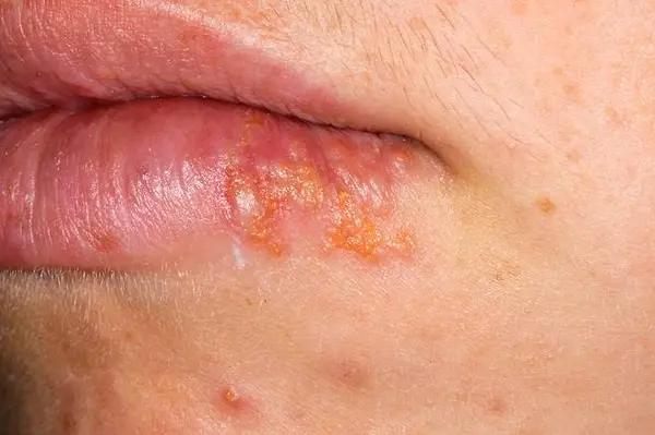 Luka di Sekitar Bibir 