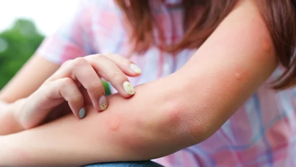 The Science of 'Mosquito Magnets': Why You Get Bitten and How to Stop It