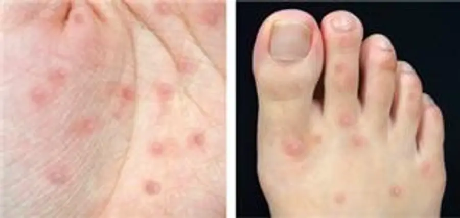 A characteristic rash on the hands and feet. Photo=Seoul National University Hospital
