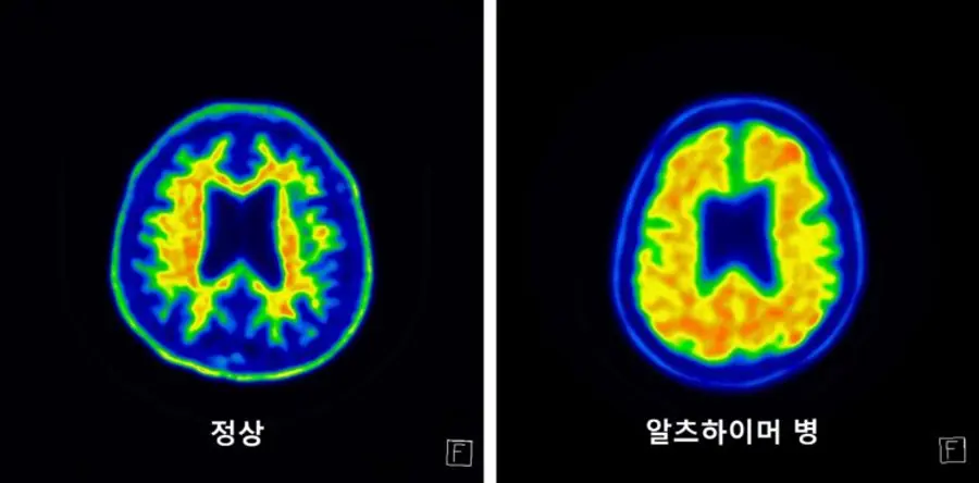 Amyloid PET images showing a normal brain (left) and amyloid buildup from Alzheimer’s disease (right). Photo: Seoul St. Mary’s Hospital